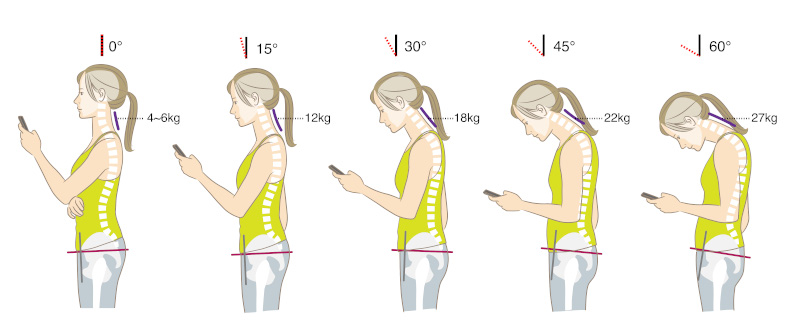 skeletal diagram of neck tilt angle and load, hunchback and posterior pelvic tilt