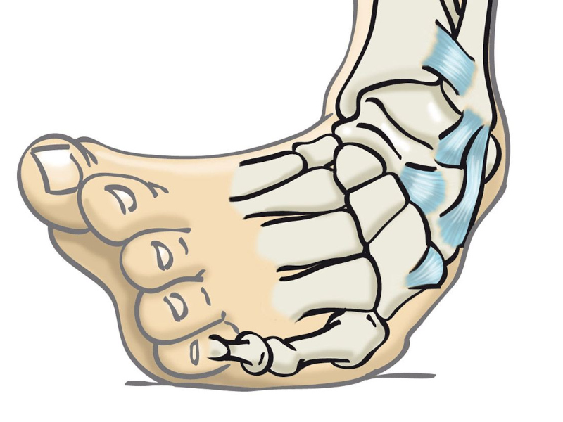 Esguince de tobillo en futbolistas