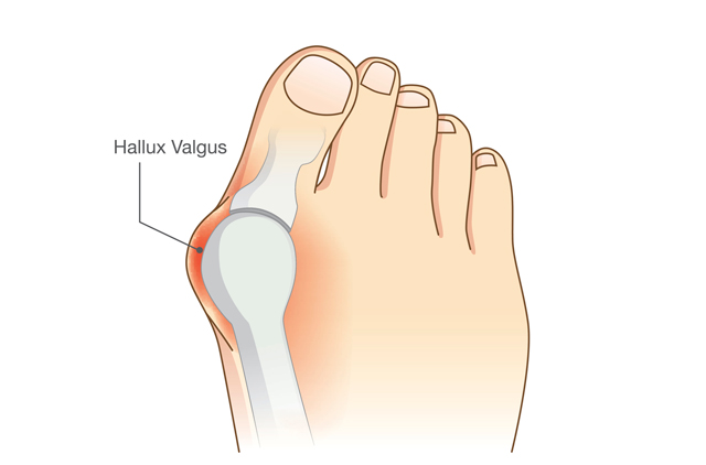 Lesiones producidas por los pies de gato: ¿Qué puedo hacer?