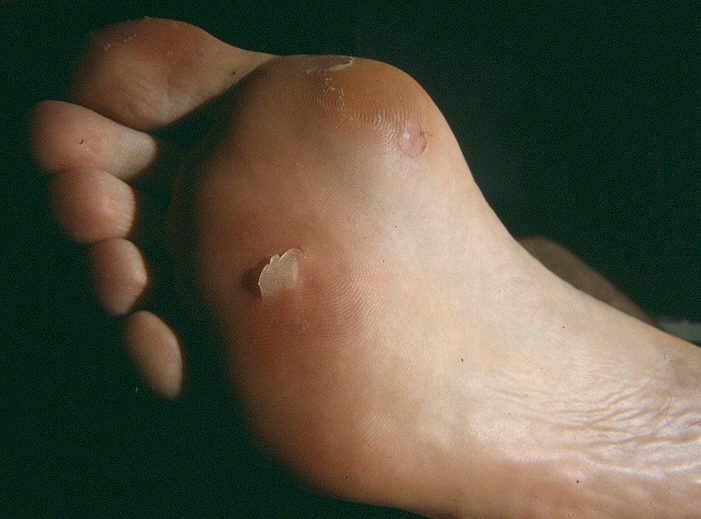 Consejos para cuidar los pies en la montaña