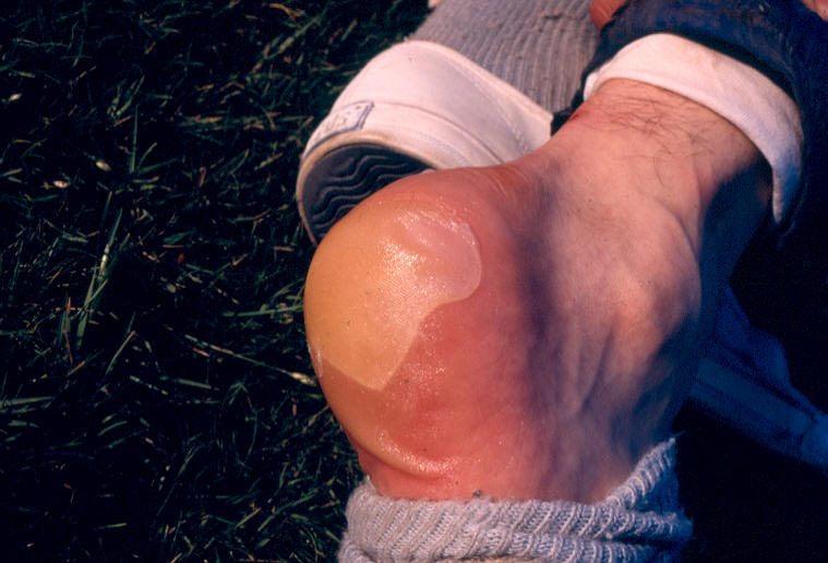 Consejos para cuidar los pies en la montaña