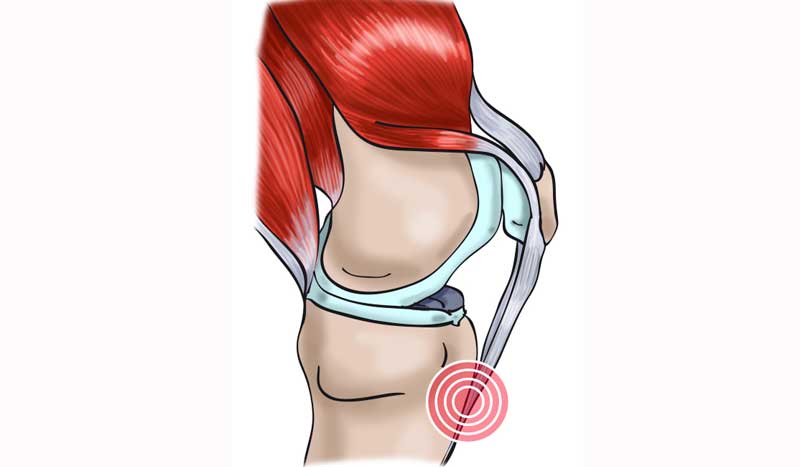 tendinitis rotuliana